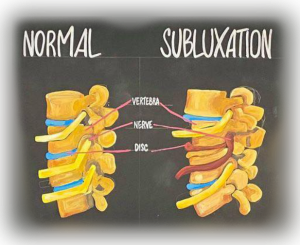 Vertebral-subluxation