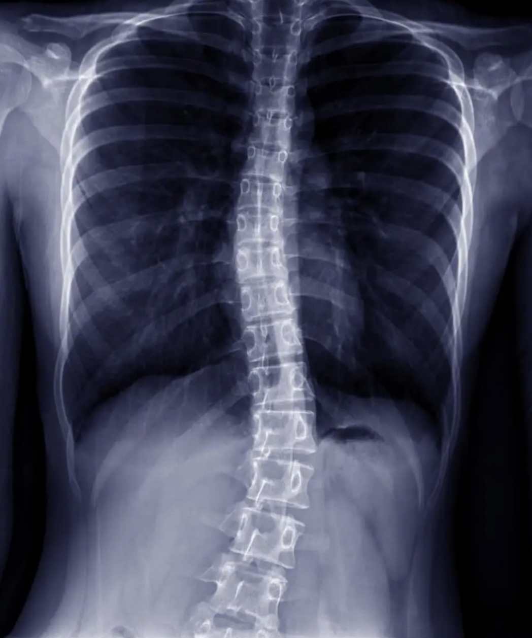 How To Do A Basic Test For Scoliosis At Home - Chiropractic Life