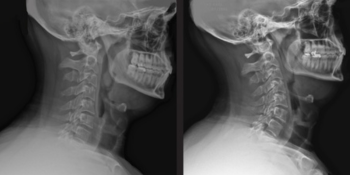 before after xray